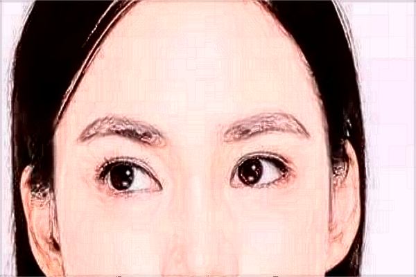 割雙眼皮需要多少錢一次?割雙眼皮需要恢復(fù)多長(zhǎng)時(shí)間?