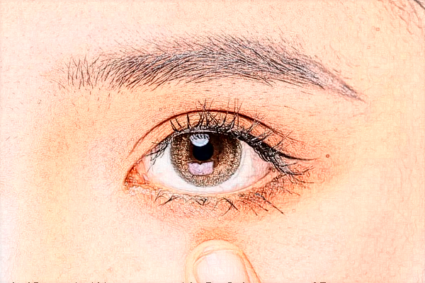 2024上海伊萊美去眼袋做的好嗎【附去眼袋案例】