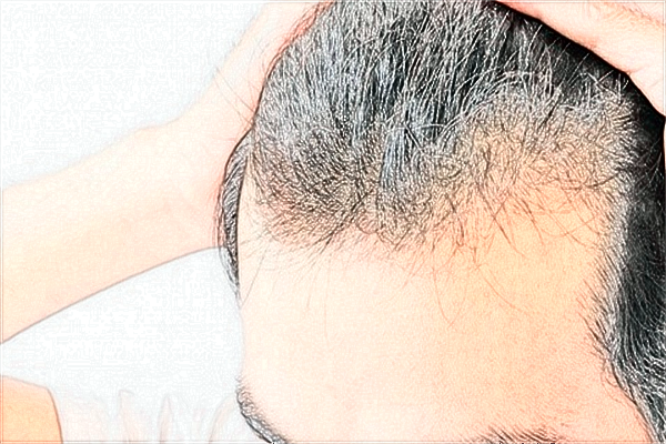 2024上海長(zhǎng)征醫(yī)院植發(fā)價(jià)格表(價(jià)目表)全覽