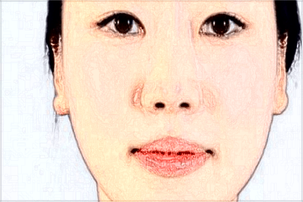 廣州海峽拉皮可以祛除法令紋嗎?拉皮價格貴嗎?