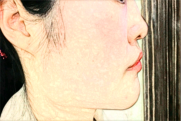 成都華西醫(yī)院祛斑價目表_祛斑后的注意事項有哪些