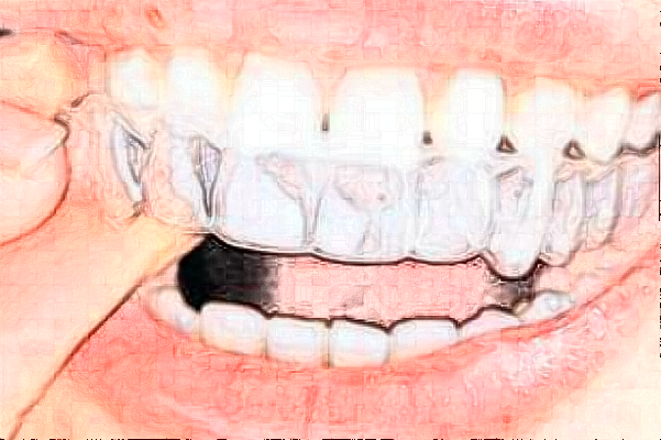重慶醫(yī)科大學附屬口腔醫(yī)院隱形牙套矯正手術做的好嗎_誰做的比較好