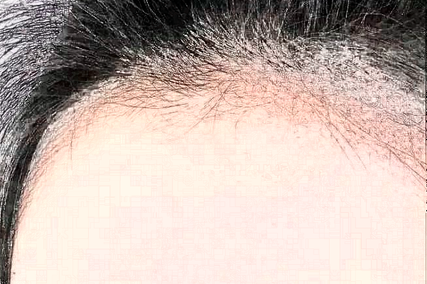 　　發(fā)際線不好看、大量脫發(fā)導(dǎo)致禿頂?shù)那闆r等，會給朋友們帶來很大的煩惱，這種情況可以選擇植發(fā)手術(shù)來，大連醫(yī)科大學(xué)附屬第一醫(yī)院做植發(fā)的技術(shù)比較不錯，根據(jù)大連地區(qū)網(wǎng)絡(luò)檢索的結(jié)果，比較常見的是發(fā)際線價格一般會在1100-38000元左右不等，比較常見的頭頂加密植發(fā)價格一般會在900-9300元左右不等，以上給出的價格僅供于參考，具體詳細(xì)的價格還需要到醫(yī)院找醫(yī)生進(jìn)行面診之后來獲取。  　　1、2024大連醫(yī)科大學(xué)附屬第一醫(yī)院植發(fā)案例  　　很多年前自己一直脫頭發(fā)，其實(shí)這也屬于正常的反應(yīng)，因?yàn)轭^發(fā)都會有一個新陳代謝，隨著時間的增加，自己的頭發(fā)脫的有點(diǎn)多，每一次洗頭發(fā)的時候都掉一大把，當(dāng)時也沒有太在意，一次無意間發(fā)現(xiàn)了自己頭頂?shù)念^發(fā)有一些稀少，這才意識到了脫發(fā)的嚴(yán)重性，所以想通過植發(fā)手術(shù)來，在家人的陪同下來到了大連醫(yī)科大學(xué)附屬第一醫(yī)院，跟醫(yī)生說明了自己掉發(fā)的情況，并且問了醫(yī)生能不能做植發(fā)手術(shù)，醫(yī)生采取診斷之后建議說可以做植發(fā)手術(shù)，所以配合了醫(yī)生的工作，整體手術(shù)操作大概用了不到三個小時左右的時間，術(shù)后就能夠看到一些植發(fā)的痕跡，在半個月之后直的頭發(fā)慢慢的長了出來，看到長出來的頭發(fā)自己的心情也愉悅了很多，終于不用擔(dān)心頭發(fā)稀少的問題帶來的困擾了。  　　2、2024大連醫(yī)科大學(xué)附屬第一醫(yī)院簡介  　　大連醫(yī)科大學(xué)附屬第一醫(yī)院整形美容科是一個集醫(yī)療、教學(xué)、科研、預(yù)防為一體的大型綜合性醫(yī)院，醫(yī)院包括有美容外科、整形外科、頜面美容外科、皮膚激光美容外科等，醫(yī)院開展的手術(shù)項(xiàng)目有先天性和創(chuàng)傷性的畸形修復(fù)、除皺、乳房整形、減肥、面部年輕化抗衰老、植發(fā)、手術(shù)、手術(shù)等多個項(xiàng)目，醫(yī)院多年的發(fā)展結(jié)合了先進(jìn)的技術(shù)和設(shè)備儀器，建立了一個重大特色的項(xiàng)目合作單位，并定期會派專業(yè)的醫(yī)護(hù)人員進(jìn)行整形美容技術(shù)學(xué)術(shù)交流和研討，為廣大女性朋友在求美的道路上制定個性化的醫(yī)美服務(wù)，醫(yī)院內(nèi)的醫(yī)生都有著先手的操作手法，組建了一支技術(shù)精湛的醫(yī)生團(tuán)隊(duì)，會為女性朋友在秋美的道路上所需求，進(jìn)行個性化的設(shè)計和診斷，得到了很多朋友們的一致好評。
