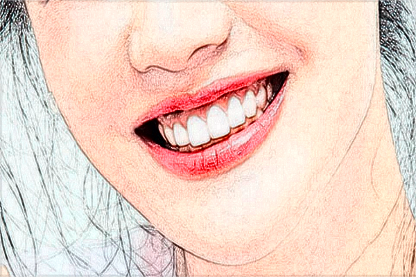 2024哈爾濱醫(yī)科大學附屬第二醫(yī)院牙齒矯正做的好不好【牙齒矯正案例反饋】