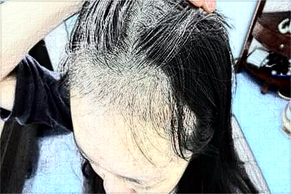 南通大學(xué)附屬醫(yī)院植發(fā)做的好嗎？誰做的好