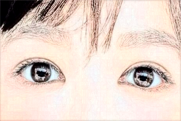 2024大連醫(yī)科大學附屬第一醫(yī)院做雙眼皮做的好嗎?整形日記分享