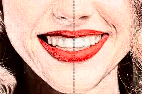 上海華美醫(yī)療美容醫(yī)院樹脂補(bǔ)牙價(jià)目(價(jià)格)表_怎么樣