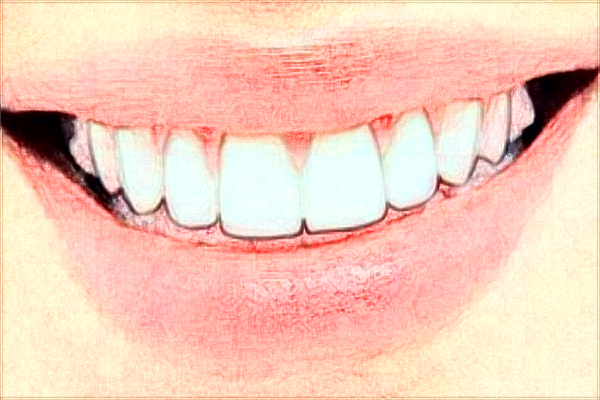 成都新橋口腔醫(yī)院根管疼嗎?根管的注意事項