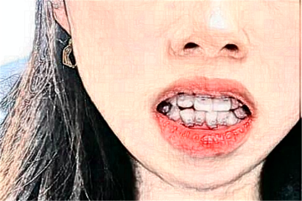 遼寧省人民醫(yī)院全口種植價目表(價格表)_口碑怎么樣