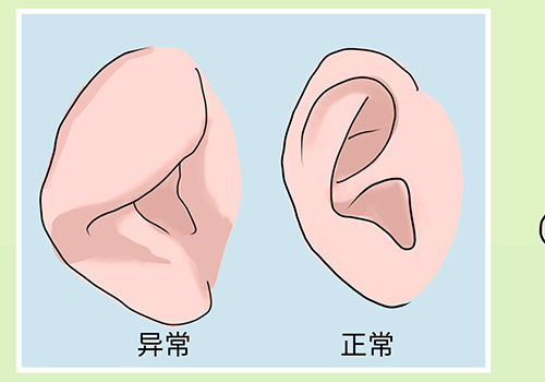 廣東佛山市第二人民醫(yī)院耳朵矯正技術(shù)風(fēng)格怎么樣?術(shù)后三個月案例曝光