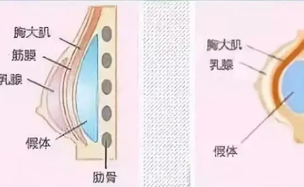 上海萬麗醫(yī)療美容門診部女性隆胸技術怎么樣?120天術后恢復案例
