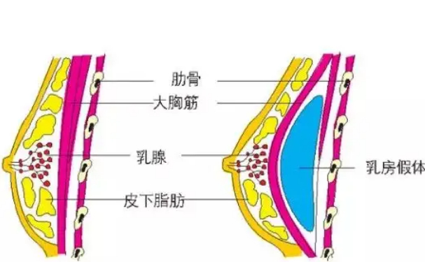 杭州市一醫(yī)院醫(yī)學(xué)美容科假體隆胸150天術(shù)后案例展示|技術(shù)優(yōu)勢(shì)怎么樣?多少錢