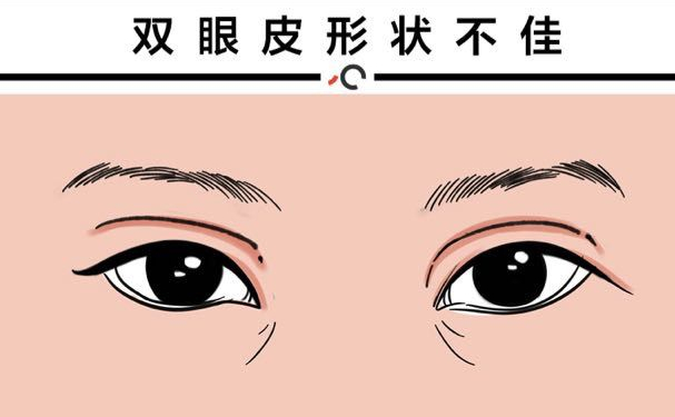 杭州蕭山詮昕醫(yī)療美容門診部扇形雙眼皮費用查詢?技術評測&術后三個月案例曝光