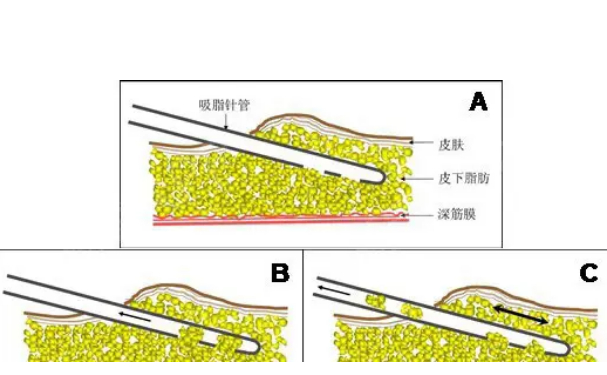 資陽(yáng)市第一人民醫(yī)院共振吸脂醫(yī)生排名,費(fèi)用查詢(xún)?求美案例