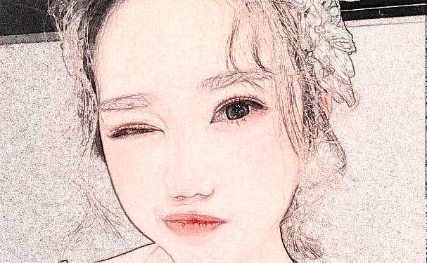 西南醫(yī)科大學(xué)附屬醫(yī)院玻尿酸去黑眼圈怎么樣?多少錢?術(shù)后120天案例&技術(shù)風(fēng)格