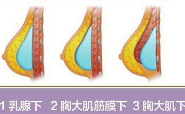 廣西醫(yī)科大學(xué)第一附屬醫(yī)院隆胸技術(shù)怎么樣?口碑詳情|價(jià)目一覽表