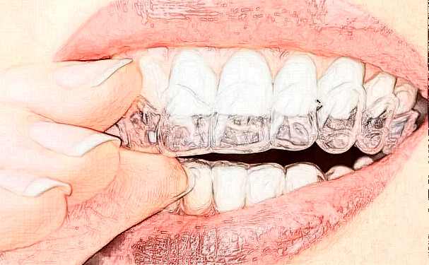 涼山彝族自治州第二人民醫(yī)院牙套正畸技術(shù)怎么樣?口碑反饋